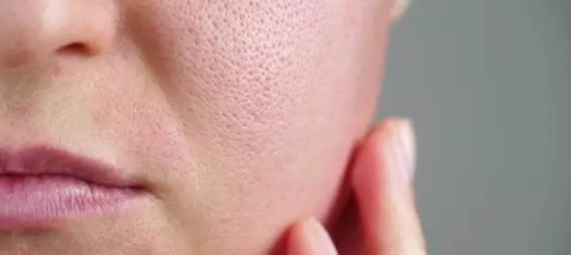 5 أسباب لظهور المسام الكبيرة في الوجه