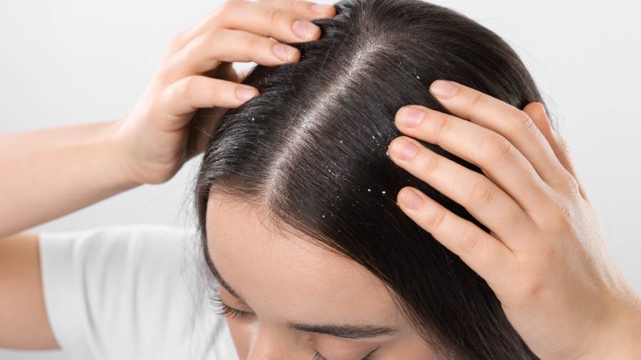 طرق طبيعية للتخلص من قشرة الرأس في المنزل