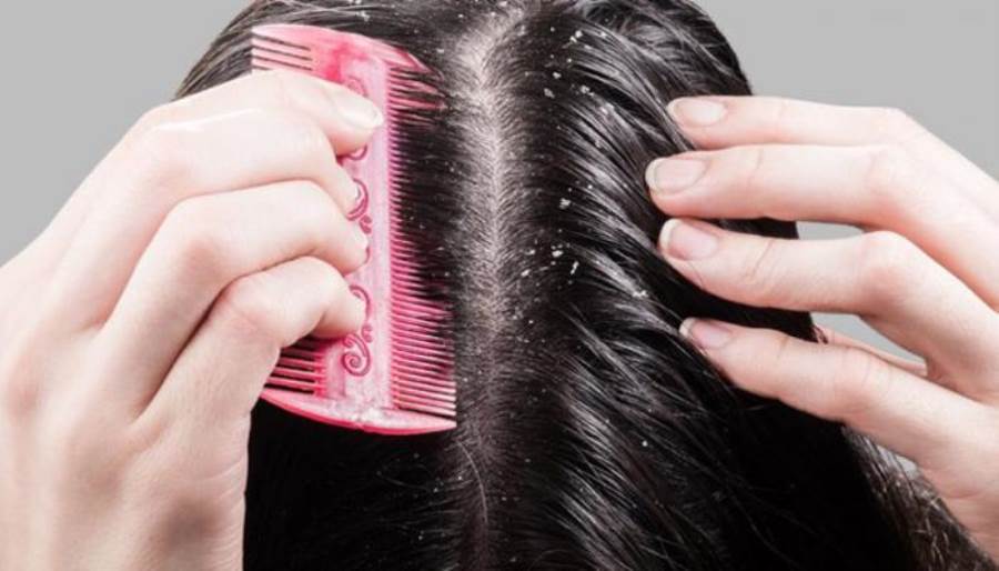 تعرفي على أسباب قشرة الرأس الدهنية وطرق علاجها