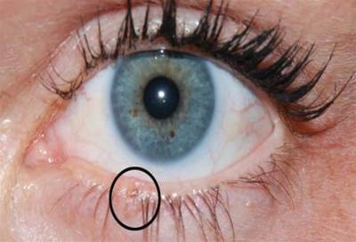 بشري لمرضي سرطان العين .. عقار جديد يجنب خطر العمى 