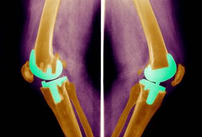 أيهما الأفضل .. الاستبدال الكامل للركبة أم الجزئي؟