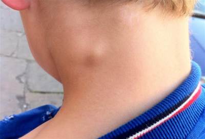 "Zevalin" دواء يقاوم الورم الليمفاوي ويبقيه بعيدًا