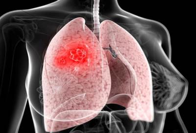 عراقي يحصل على براءة اختراع تطوير ادوية الرئة المستنشقة