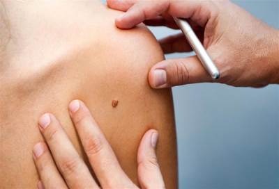 ضوابط وأنواع فحوصات تشخيص سرطان الجلد