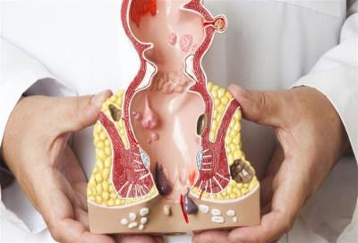 العملية الجراحية .. ليست العلاج الوحيد للبواسير