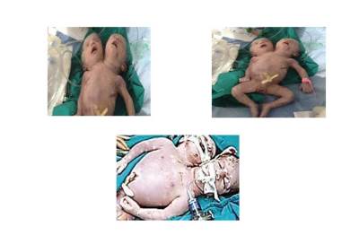 حالة نادرة في مصر .. امرأة تضع طفلاً برأسين وقلب واحد