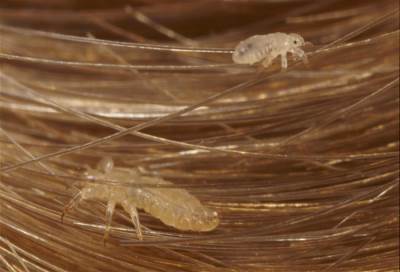 علاج جديد لمكافحة قمل شعر الرأس