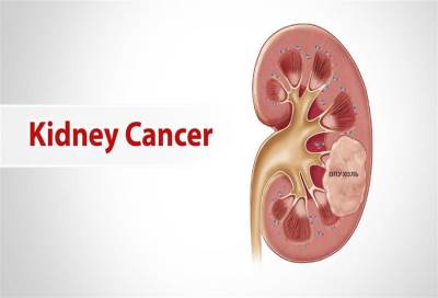 عقار جديد يفتح باب الأمل لمرضى سرطان الكلى