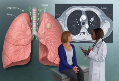 معدل الوفيات بين النساء المدخنات في ارتفاع متزايد .. بسبب سرطان الرئة