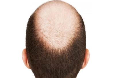 بحث طبي فريد من نوعه قد يساعد في علاج الصلع .. فئران صلعاء تستعيد شعرها