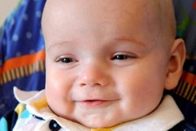 كسر جمجمة رضيع 4 أجزاء لإنقاذه من تشوه بالرأس