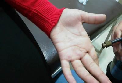 العلاج بالتبريد أنقذ حياة رضيع بريطاني .. نزف 85% من دمه ونجا من الموت