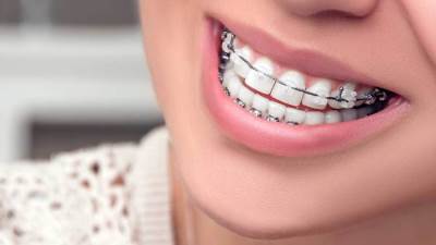 تشويه الأسنان .. بدعة نسائية في عمليات تجميل لجذب الرجال