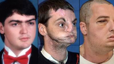 جراحة فريدة من نوعها لزراعة وجه كامل