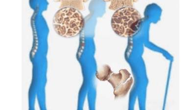 نقص المنجنيز .. السبب في حدوث هشاشة العظام