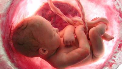 أول جراحة ناجحة بالعالم لاستئصال ورم من فم جنين ببطن أمه