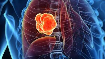 أسمنت وإبر وبالون للتخلص من سرطان المايلوما