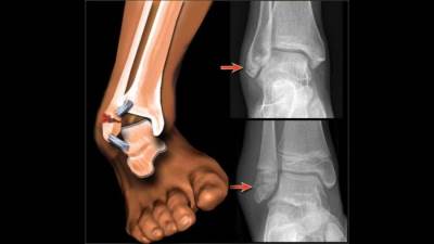 حوادث السير تؤذي عظمة الكاحل .. ونجاح حلول استبدالها