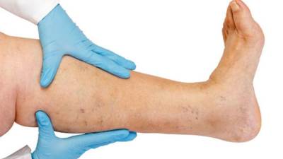 الجوارب الضاغطة .. هل تفيد في تجنب تكرار حدوث جلطات الأوردة العميقة؟