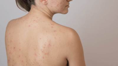 إليك عشرين طريقة فريدة لعلاج بثور الظهر