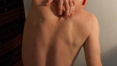 رجل يحك ظهره ويجد سكينا مغروسا به منذ ثلاث سنوات