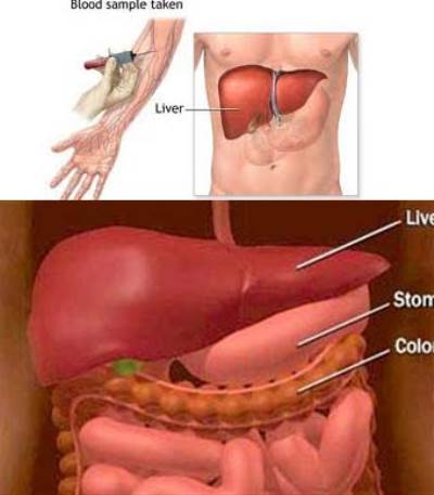 إخصائي كبد : ارتفاع نسبة وظائف الكبد لا يعتبر مؤشرًا على فشله
