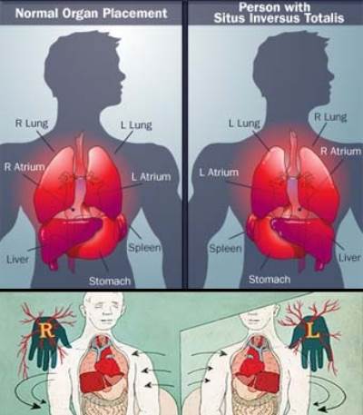 عندما يكون القلب في الجهة اليمنى .. لا اليسرى
