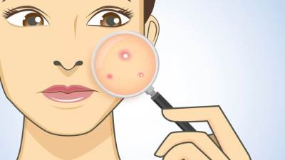 هكذا تنتقل البثور من الوجه إلى الجسم