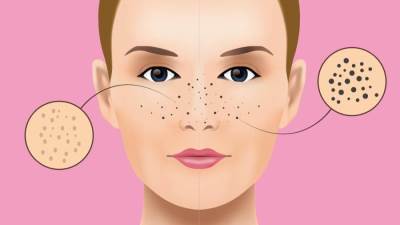 5 طرق طبيعية للتخلص من الرؤوس السوداء