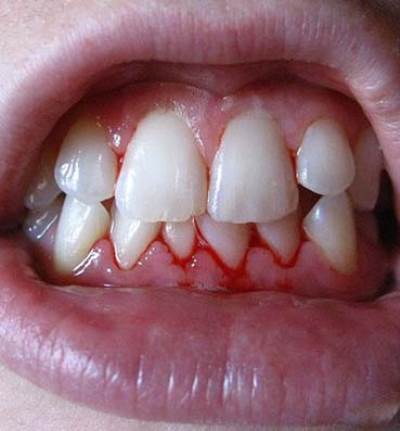 أسباب وطرق الوقاية من نزيف اللثة