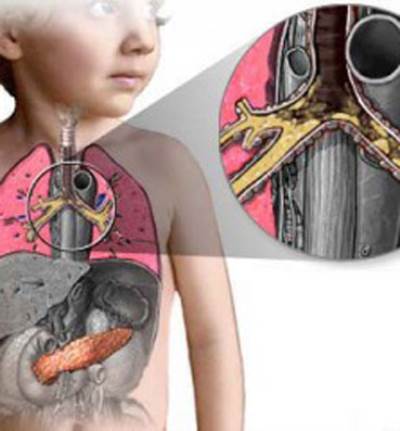 مرض التليف الكيسي .. مرض وراثي خطير