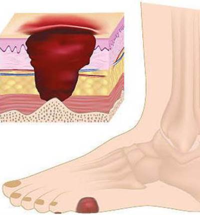  الدليل الكامل لأعراض وعلاج الاعتلال العصبي السكري