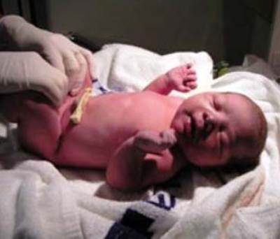 ختان الذكور .. وقاية من الأمراض التناسلية