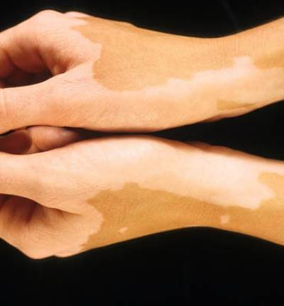 العلاقة بين البهاق واضرابات المناعة الذاتية