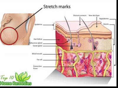 علاجات طبيعية أكثر فاعلية لعلاج علامات التمدد في الجسم