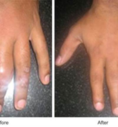  العلاج والرعاية الذاتية للصدفية