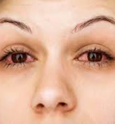 أسباب احمرار العينين في الصيف وعلاجها