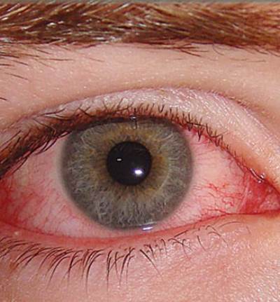 الدليل الكامل لأسباب وعلاج مرض «المياه الزرقاء»