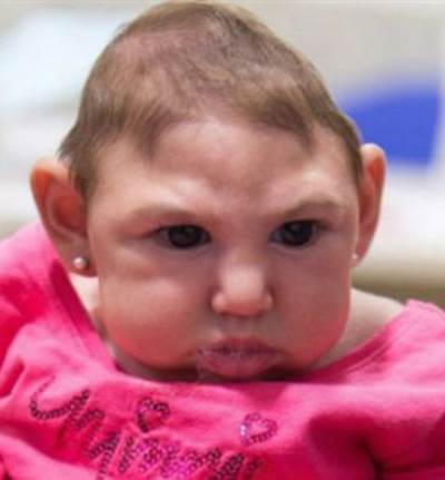 تعرف على أسلوب "زيكا" فى تدمير مخ الأجنة