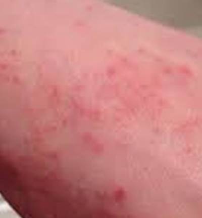 طريقة عمل كريم لعلاج الإكزيما في المنزل 