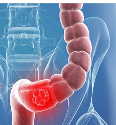 طرق فعالة للكشف المبكر عن سرطان الأمعاء