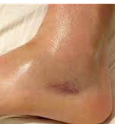 تورم الجسم أثناء الأنفلوانزا ينذر بالخطر .. احذريها