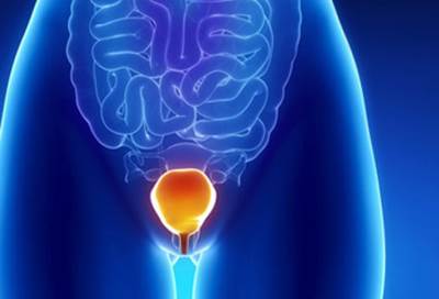 استخراج حصاة تزن نصف كيوجرام من مثانة رجل