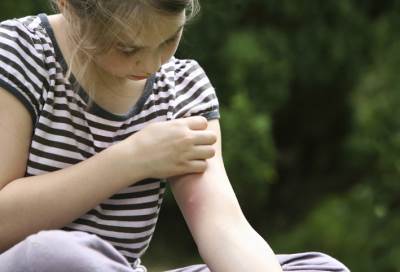 طريقة سهلة للتخلص من لسعة البعوض