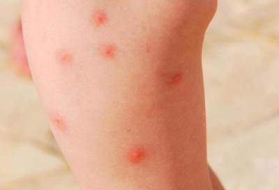 هكذا تتعامل مع لدغات البعوض