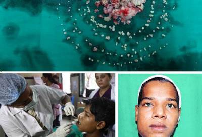 واقعة أغرب من الخيال .. في فم مراهق 232 سناً!