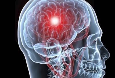 تعرف على أعراض وأنواع السكتة الدماغية