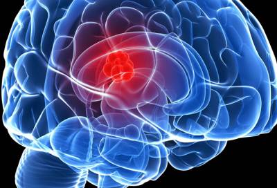 طرق علاج الورم النجمي