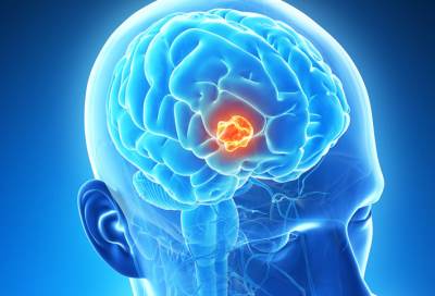 أعراض الإصابة بأورام المخ
