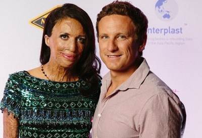 بعد تعرضها للتشوه وفقدانها أصابيعها .. عارضة الأزياء الشهيرة تضع طفلها الأول 